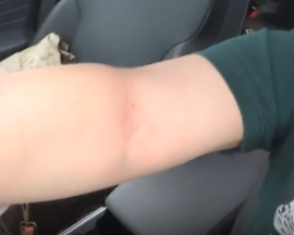 Donation Arm Rash from Trash Bags